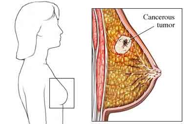 Breast cancer tumor